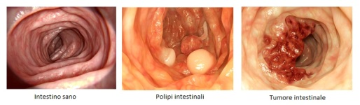 coloscopia, immagini di intestino
