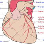 placca in arteria