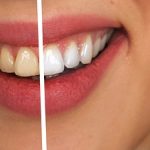sbiancamento dei denti