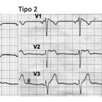 Brugada ECG pattern