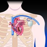 Dp schema impianto pacemaker o defibrillatore