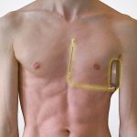 defibrillatore sottocutaneo wiki