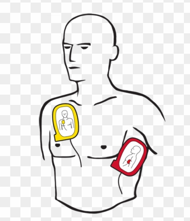 posizione degli elettrodi di defibrillazione in un defibrillatore semiautomatico