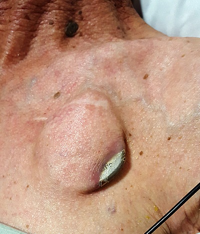 Rischi pacemaker deiscenza