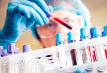 Nuovi Test Diagnostici per la diagnosi precoce del Morbo Di Alzheimer Esami di sangue